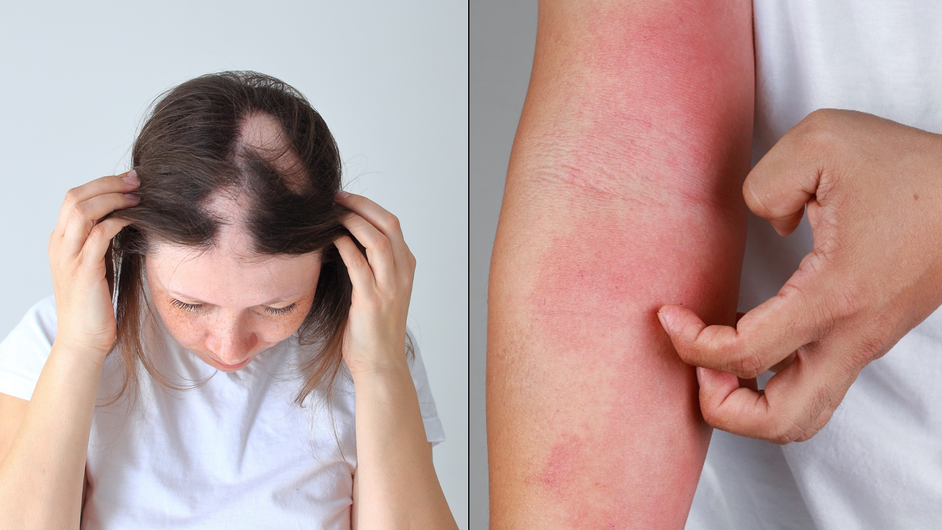 Woman with alopecia and a person's arm with eczema